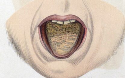 Color illustration of an open mouth showing a diseased tongue