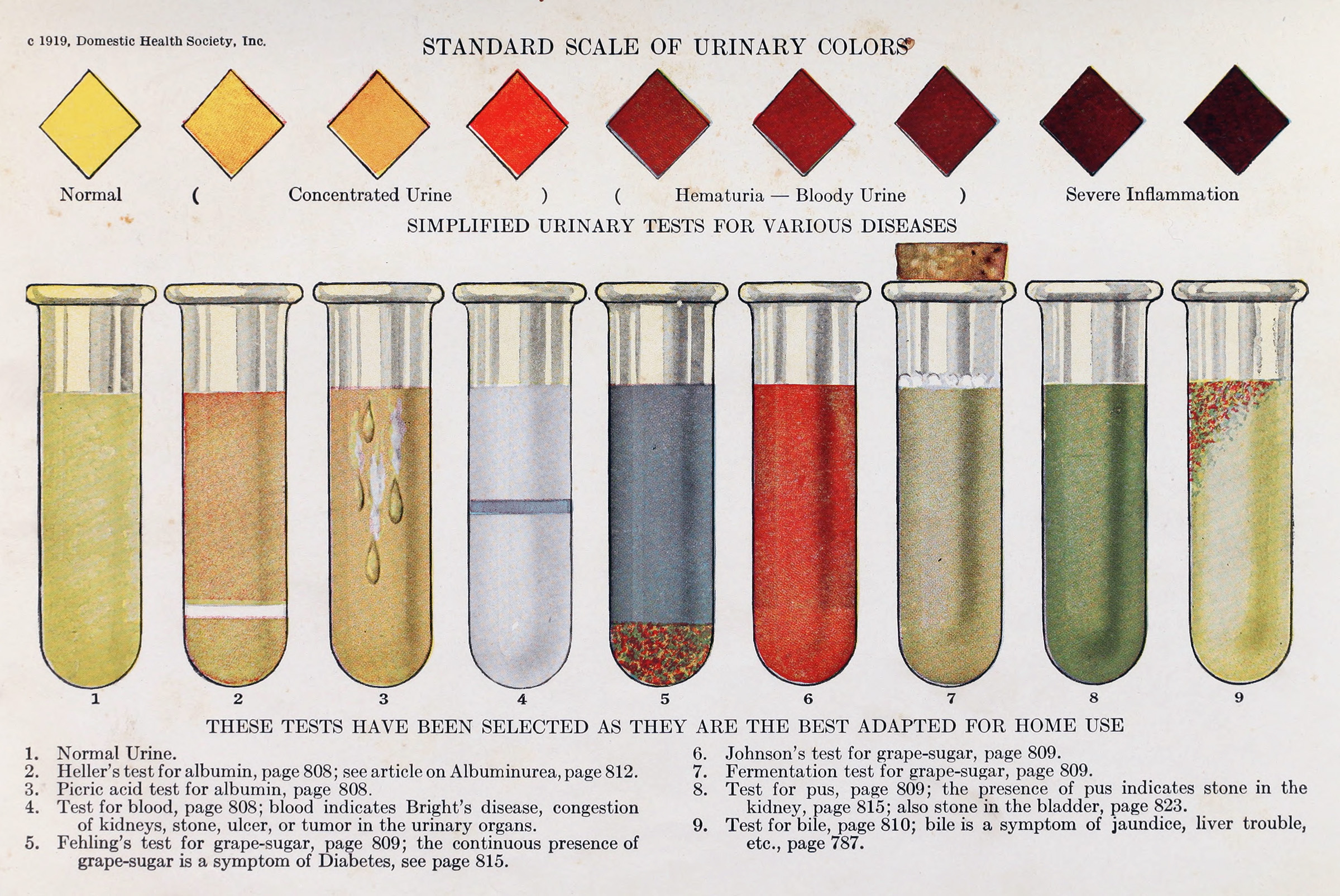 Illustration showing a urine color scale and test tubes showing various colors and consistencies